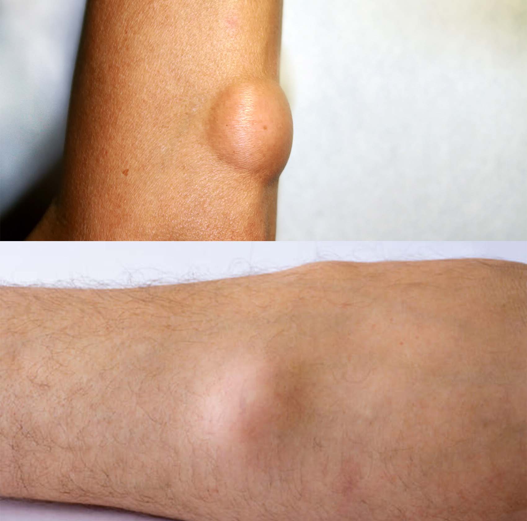 Benjolan di Tubuh Anda Bisa Jadi Lipoma, Tahu Apa Itu?