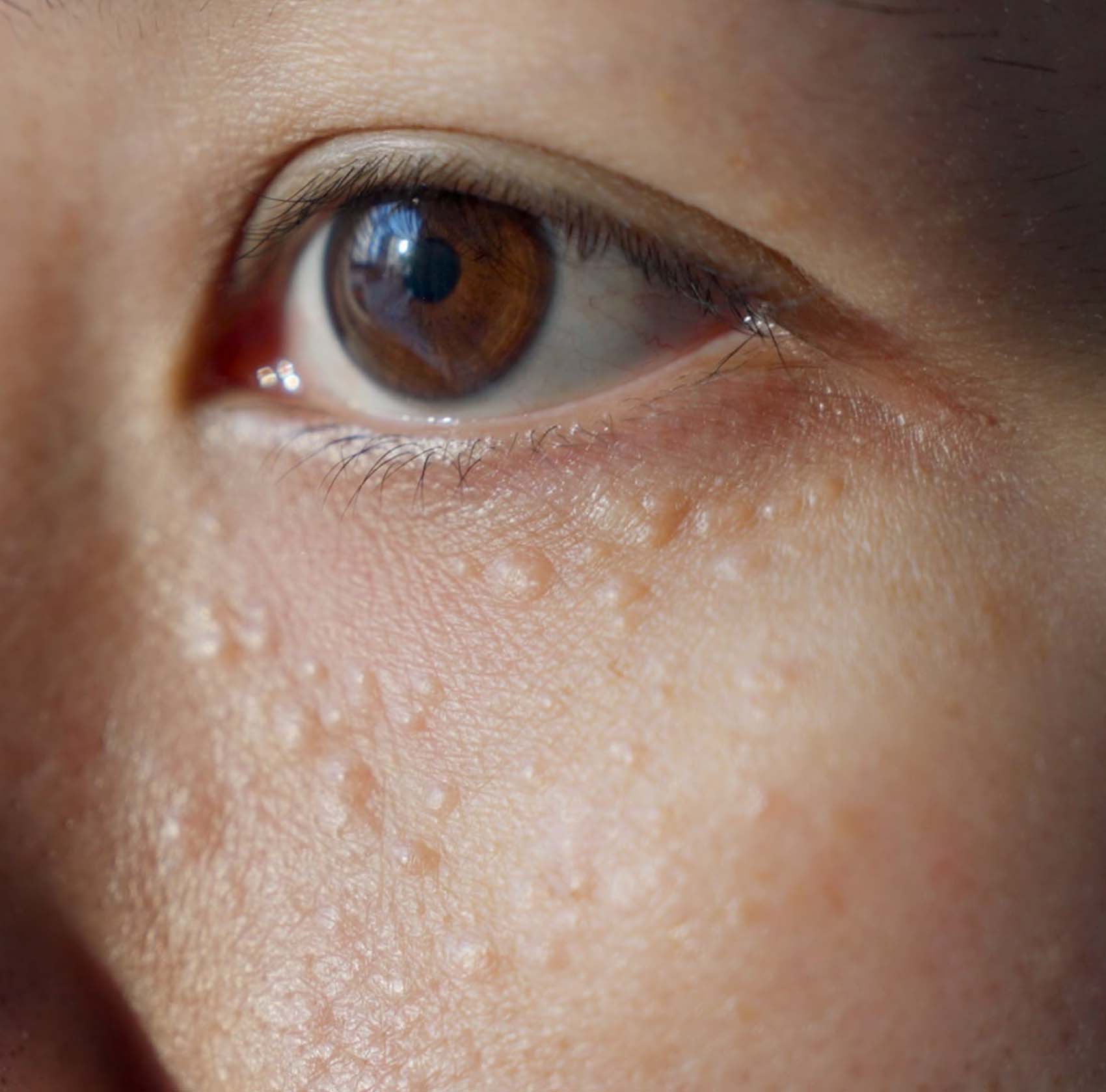 Mengenal Syringioma: Penyakit Kulit yang Jarang Diketahui