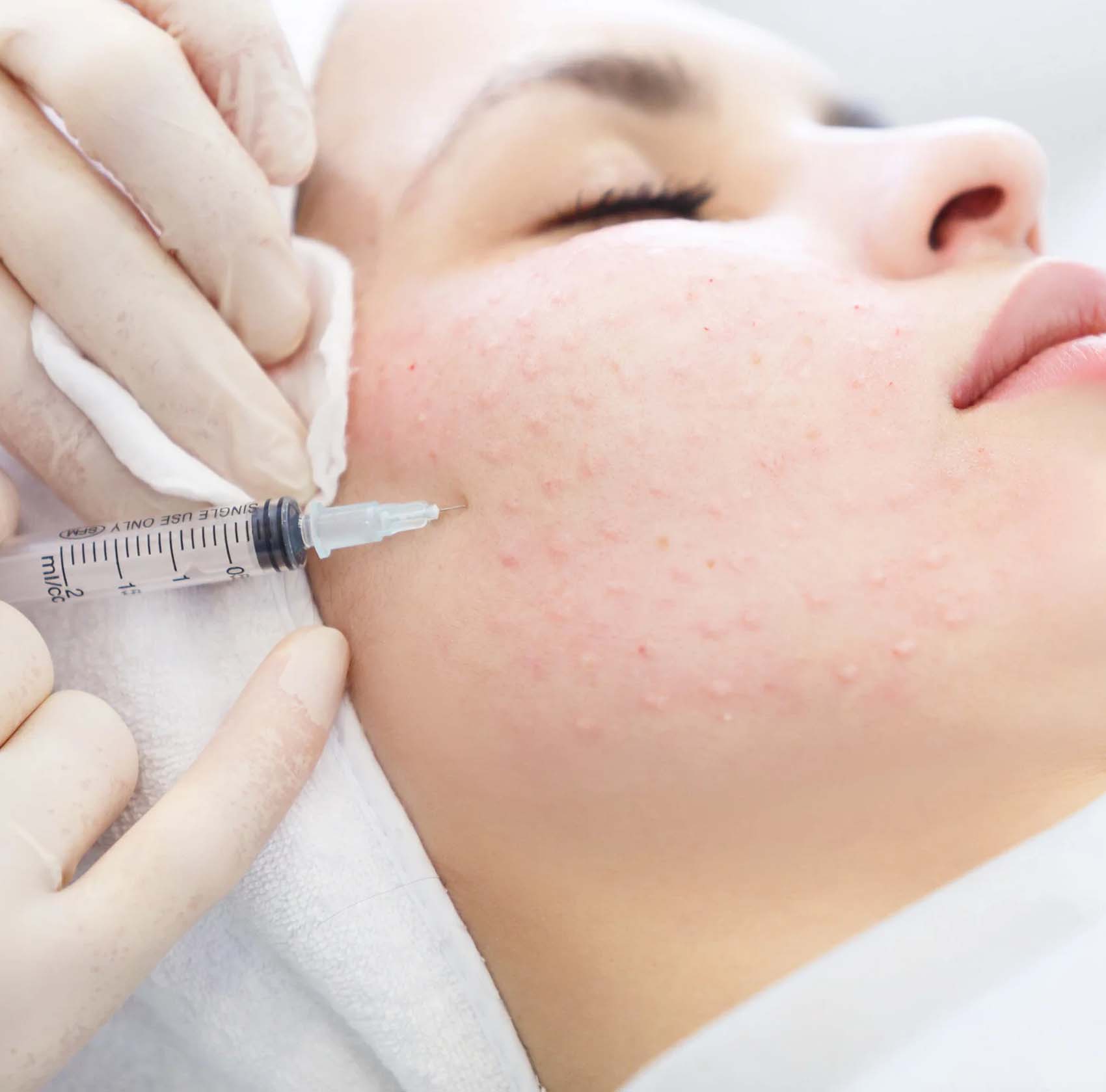 Microbotox: Manfaat Tak Terduga yang Tidak Anda Ketahui Sebelumnya